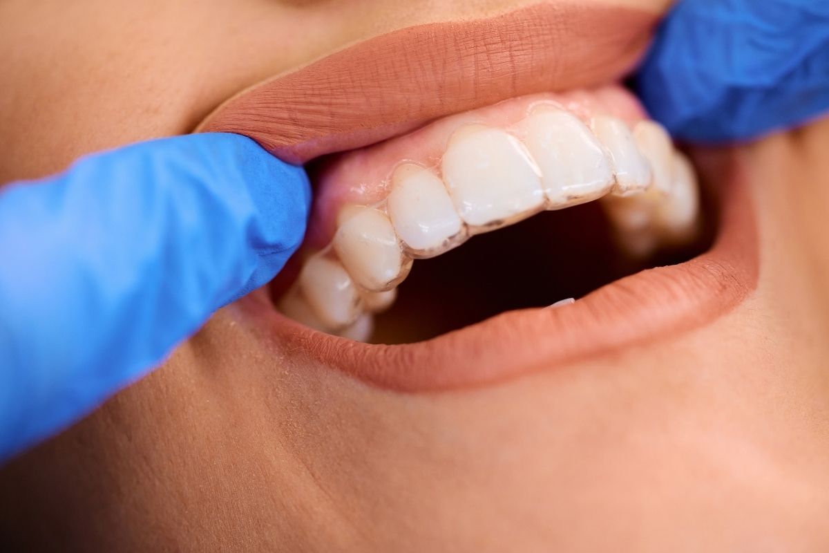 Will Your Gums Recede After Invisalign?