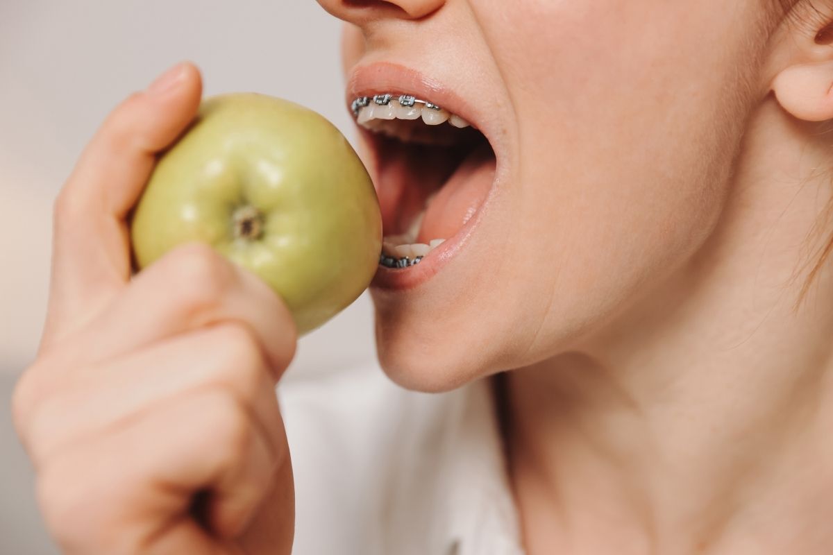 Can You Eat Normally Right After Getting Braces?